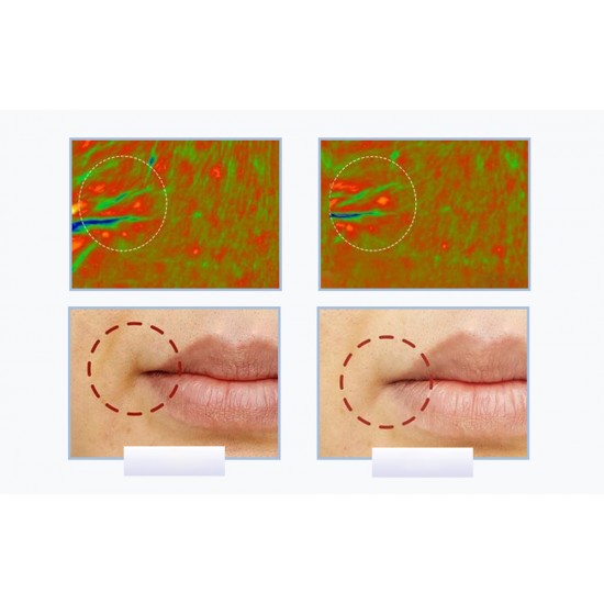 Ultrasonic facial massager with light therapy ANLAN 01-ADRY15-001